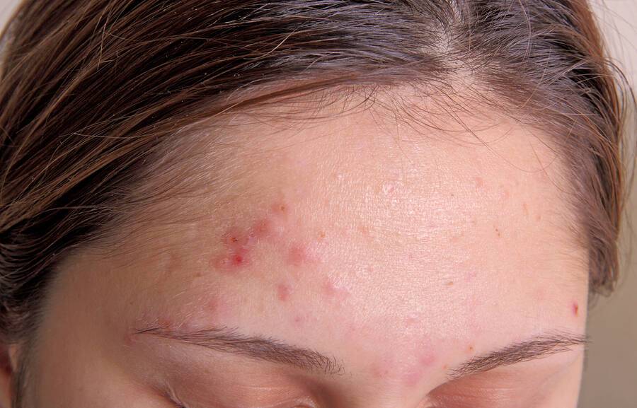 Acne on the girl's forehead. Color photo close-up