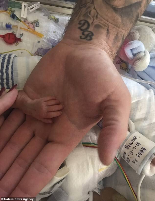 At just six minutes old, George was put on a life support machine. Pictured, his tiny hand